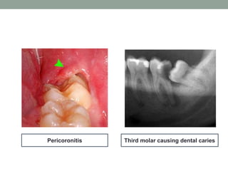 Third molar causing dental cariesPericoronitis
 