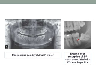 Dentigerous cyst involving 3rd molar
External root
resorption of 2nd
molar associated with
3rd molar impaction
 