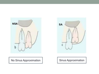 No Sinus Approximation Sinus Approximation
 