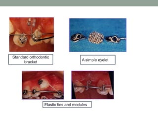 Standard orthodontic
bracket
A simple eyelet
Elastic ties and modules
 