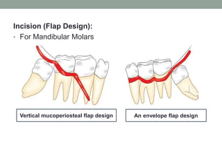 Incision (Flap Design):
• For Mandibular Molars
Vertical mucoperiosteal flap design An envelope flap design
 
