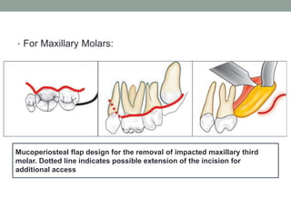 • For Maxillary Molars:
Mucoperiosteal flap design for the removal of impacted maxillary third
molar. Dotted line indicates possible extension of the incision for
additional access
 