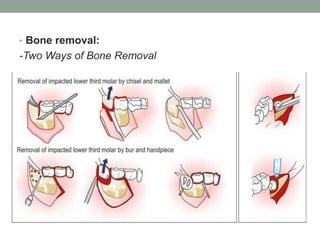 • Bone removal:
-Two Ways of Bone Removal
 