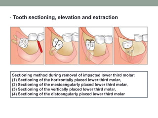 • Tooth sectioning, elevation and extraction
Sectioning method during removal of impacted lower third molar:
(1) Sectioning of the horizontally placed lower third molar,
(2) Sectioning of the mesioangularly placed lower third molar,
(3) Sectioning of the vertically placed lower third molar,
(4) Sectioning of the distoangularly placed lower third molar
 