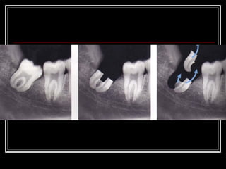 Impacted teeth Slide 103