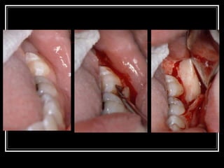 Impacted teeth Slide 104