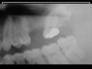 Impacted teeth Slide 116