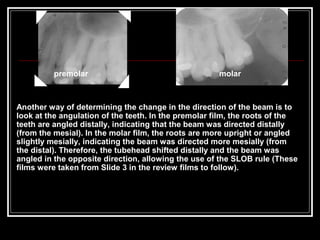 Impacted teeth Slide 185