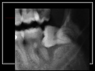Impacted teeth Slide 24