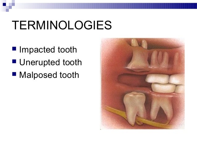 impacted tooth