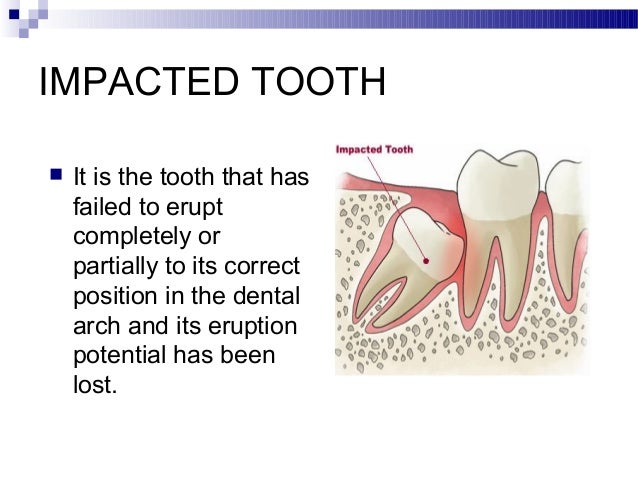 impaction impacted tooth
