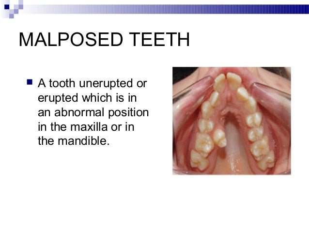 impaction impacted tooth
