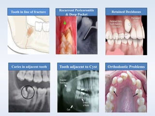 Tooth in line of fracture
Orthodontic ProblemsTooth adjacent to CystCaries in adjacent tooth
Retained DeciduousRecurrent Pericoronitis
& Deep Pocket
 