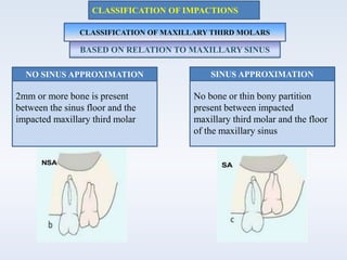 CLASSIFICATION OF IMPACTIONS
CLASSIFICATION OF MAXILLARY THIRD MOLARS
BASED ON RELATION TO MAXILLARY SINUS
NO SINUS APPROXIMATION SINUS APPROXIMATION
2mm or more bone is present
between the sinus floor and the
impacted maxillary third molar
No bone or thin bony partition
present between impacted
maxillary third molar and the floor
of the maxillary sinus
 