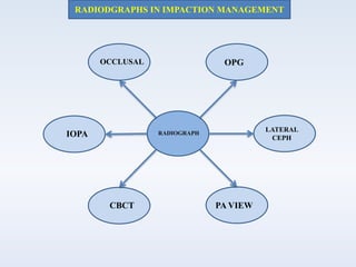 RADIODGRAPHS IN IMPACTION MANAGEMENT
OCCLUSAL OPG
RADIOGRAPH
CBCT
LATERAL
CEPHIOPA
PA VIEW
 