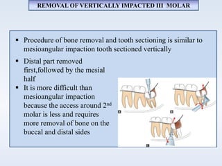 REMOVAL OF VERTICALLY IMPACTED III MOLAR
 Procedure of bone removal and tooth sectioning is similar to
mesioangular impaction tooth sectioned vertically
 Distal part removed
first,followed by the mesial
half
 It is more difficult than
mesioangular impaction
because the access around 2nd
molar is less and requires
more removal of bone on the
buccal and distal sides
 