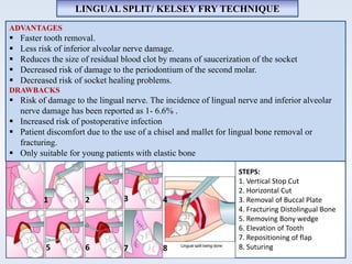 1 32 4
5 6 7 8
STEPS:
1. Vertical Stop Cut
2. Horizontal Cut
3. Removal of Buccal Plate
4. Fracturing Distolingual Bone
5. Removing Bony wedge
6. Elevation of Tooth
7. Repositioning of flap
8. Suturing
LINGUAL SPLIT/ KELSEY FRY TECHNIQUE
ADVANTAGES
 Faster tooth removal.
 Less risk of inferior alveolar nerve damage.
 Reduces the size of residual blood clot by means of saucerization of the socket
 Decreased risk of damage to the periodontium of the second molar.
 Decreased risk of socket healing problems.
DRAWBACKS
 Risk of damage to the lingual nerve. The incidence of lingual nerve and inferior alveolar
nerve damage has been reported as 1- 6.6% .
 Increased risk of postoperative infection
 Patient discomfort due to the use of a chisel and mallet for lingual bone removal or
fracturing.
 Only suitable for young patients with elastic bone
 