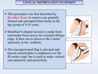 LINGUAL TREPHENATION TECHNIQUE
This procedure was first described by
Bowdler-Henry to remove any partially
formed and unerupted third molar in the
age group of 9-16 years.
Modified S-shaped incision is made from
retromolar fossa across the external oblique
ridge. It then curves down to the I molar
anteriorly in the vestibule.
The mucoperiosteal flap is elevated and
buccal cortical plate is trephined over the
III molar crypt. bur is used to make vertical
cuts anteriorly and posteriorly.
 