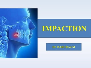 IMPACTION
Dr. BABURAJ.M
 