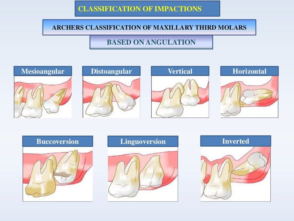 Impaction
