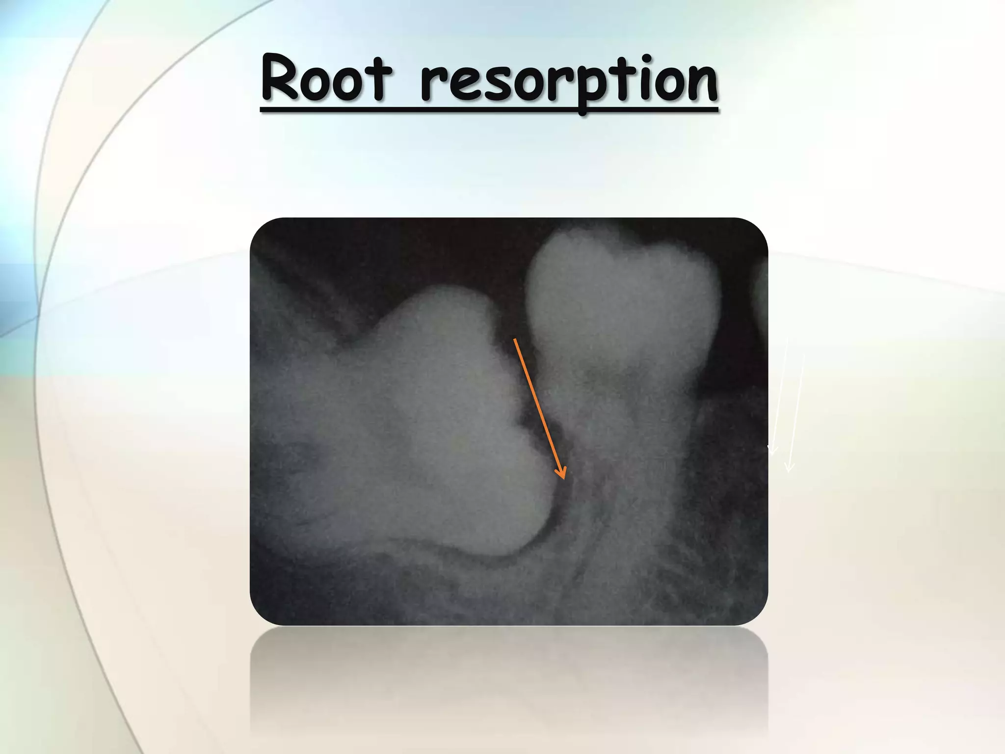 IMPACTION IN ORAL SURGERY | PPTX