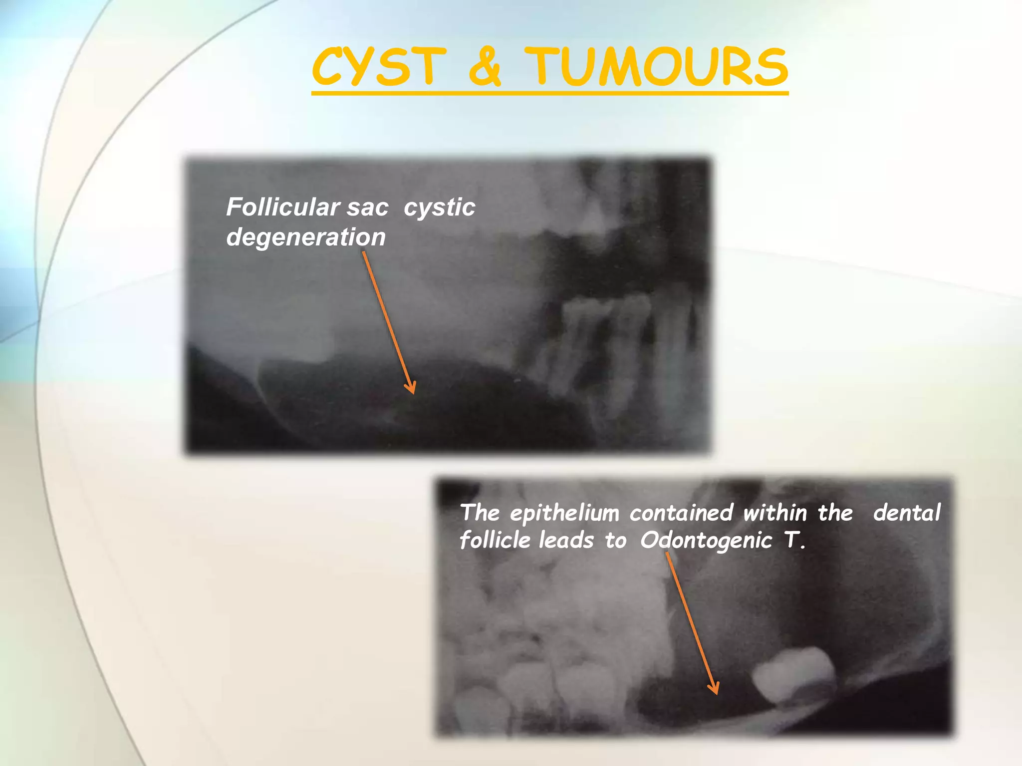 IMPACTION IN ORAL SURGERY | PPTX