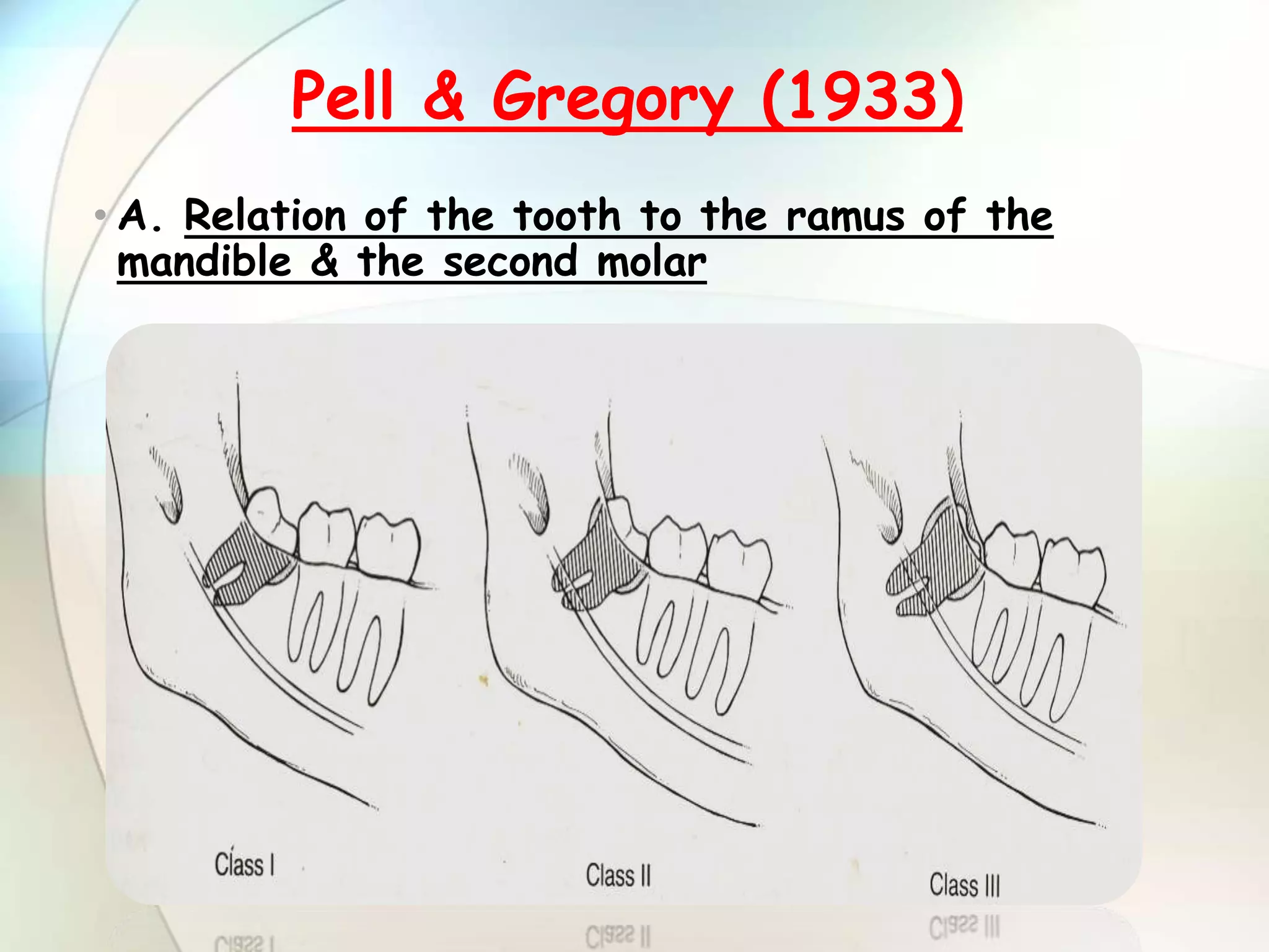 IMPACTION IN ORAL SURGERY | PPTX