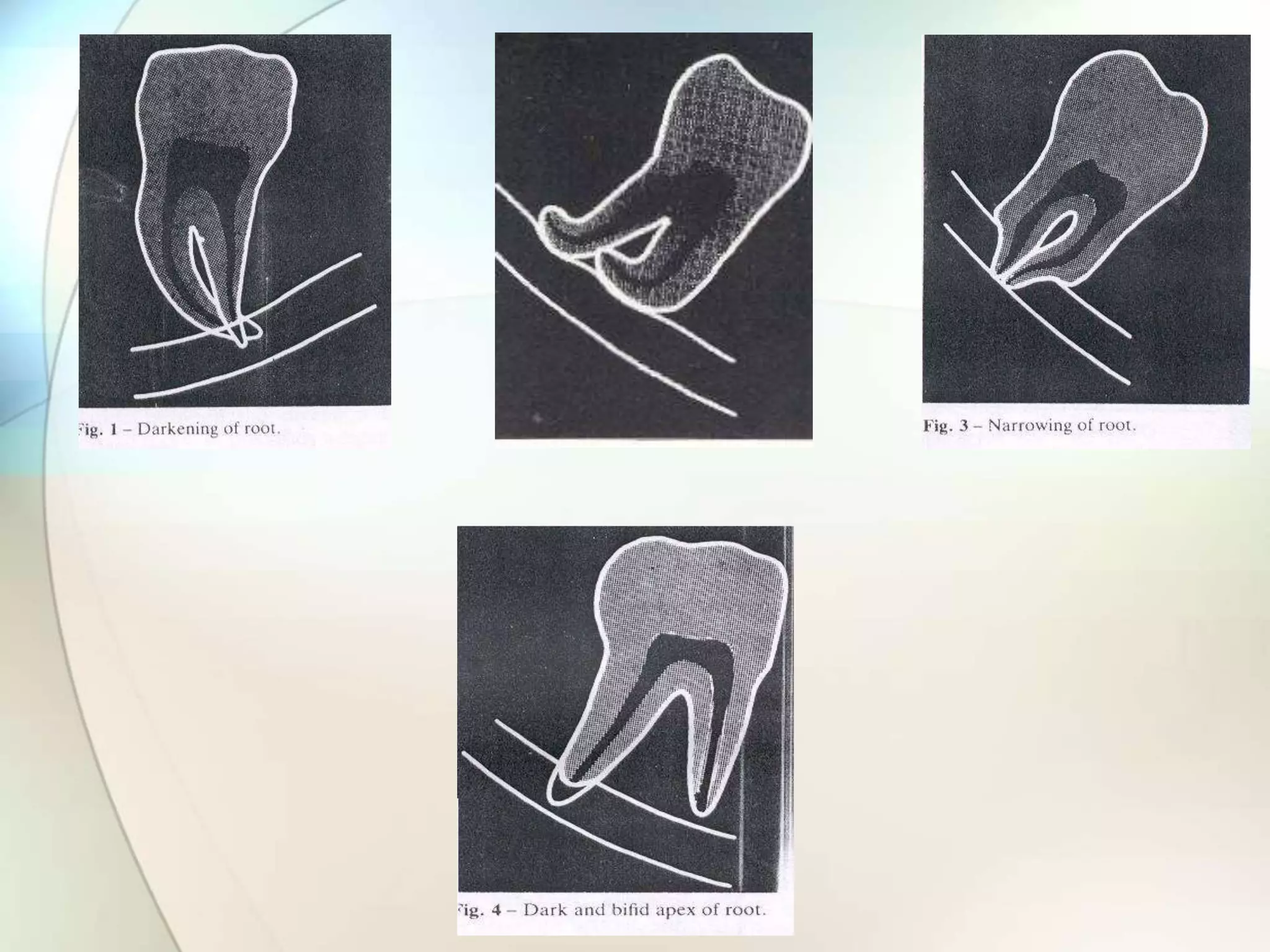 IMPACTION IN ORAL SURGERY | PPTX