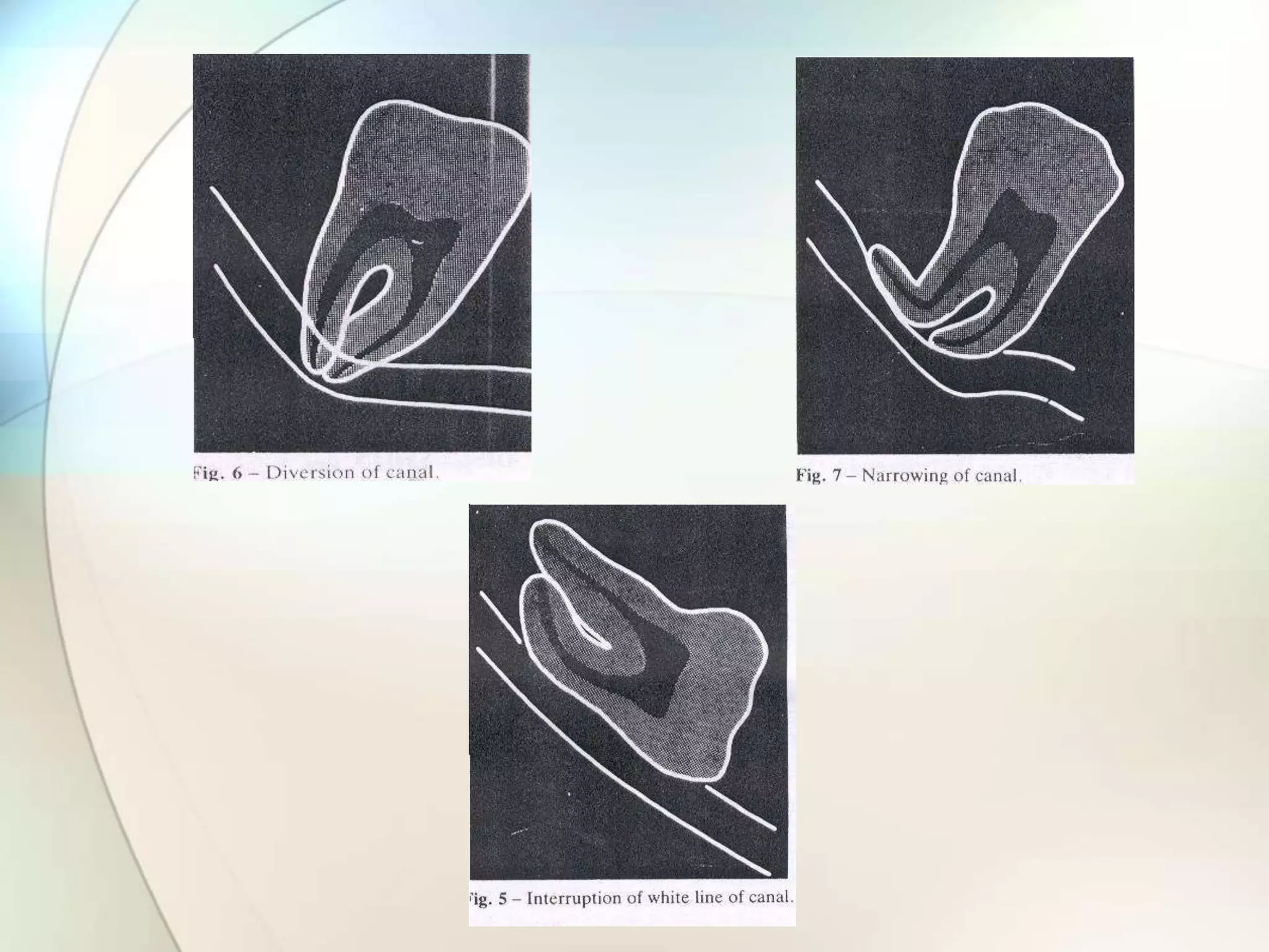 IMPACTION IN ORAL SURGERY | PPTX