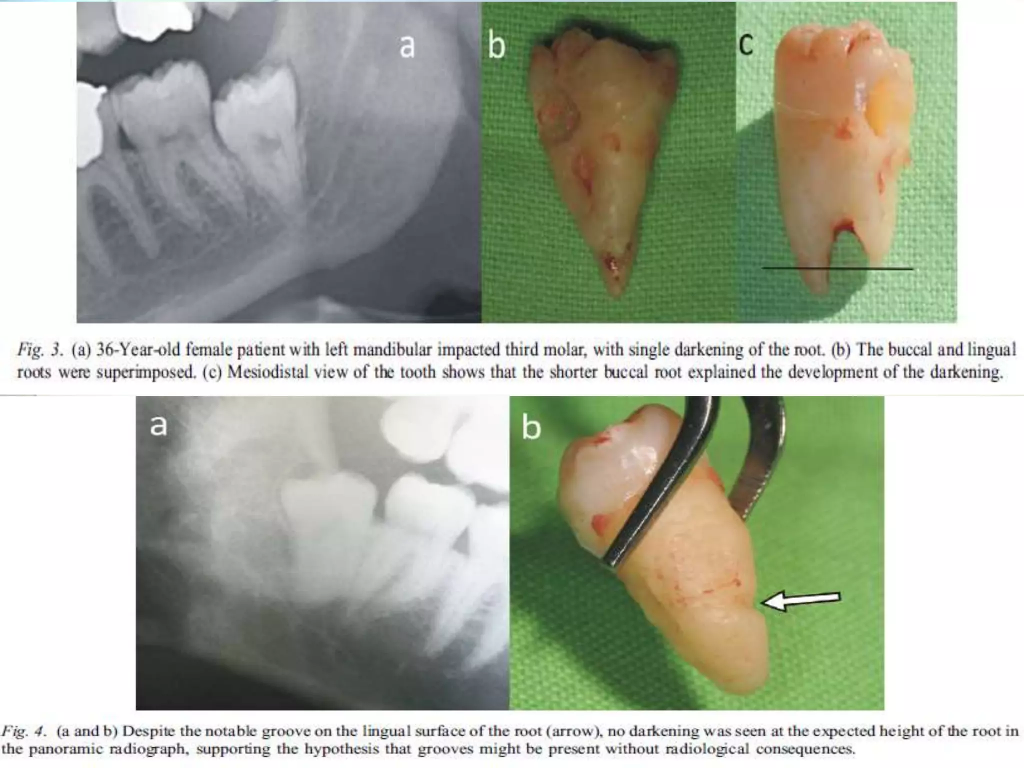 IMPACTION IN ORAL SURGERY | PPTX