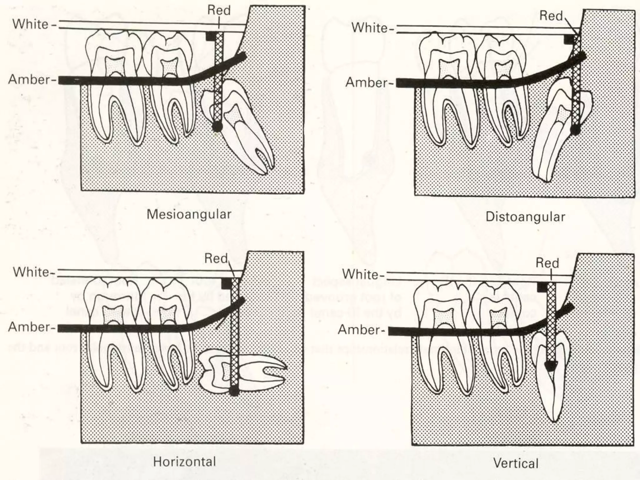 IMPACTION IN ORAL SURGERY | PPTX