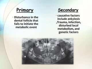 • causative factors
include ankylosis
,Trauma, infection,
disturbed local
metabolism, and
genetic factors
Secondary
• Disturbance in the
dental follicle that
fails to initiate the
metabolic event
Primary
 