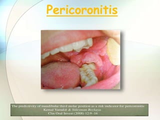 Pericoronitis
 