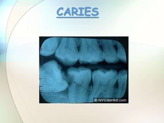 CARIES
 