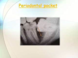 Periodontal pocket
 