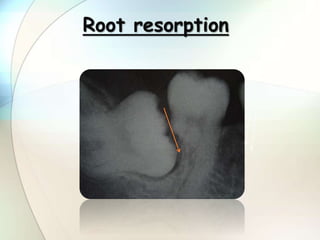 Root resorption
 
