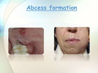 Abcess formation
 