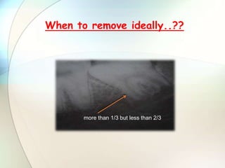When to remove ideally..??
more than 1/3 but less than 2/3
 