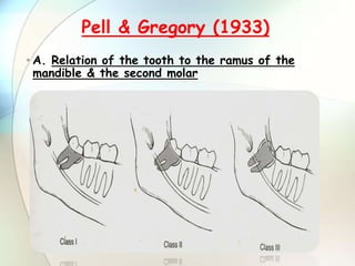 • A. Relation of the tooth to the ramus of the
mandible & the second molar
Pell & Gregory (1933)
 
