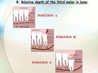 • B. Relative depth of the third molar in bone.
42
POSITION B
POSITION C
POSITION A
 