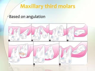 •Based on angulation
Maxillary third molars
 
