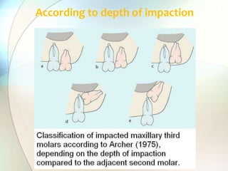 According to depth of impaction
 