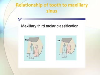 Relationship of tooth to maxillary
sinus
 