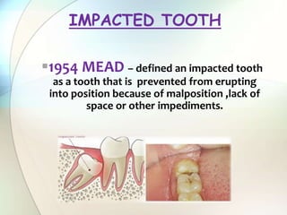 1954 MEAD – defined an impacted tooth
as a tooth that is prevented from erupting
into position because of malposition ,lack of
space or other impediments.
IMPACTED TOOTH
 