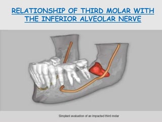 RELATIONSHIP OF THIRD MOLAR WITH
THE INFERIOR ALVEOLAR NERVE
 