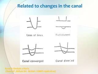 Related to changes in the canal
Rood & Shebab criteria
(Rood JP ,Shihab BA - British J OMFS 1998:28:20)
 