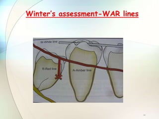 60
Winter’s assessment-WAR lines
 