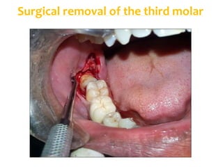Surgical removal of the third molar
 