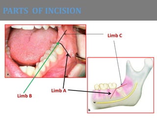 PARTS OF INCISION
Limb A
Limb B
Limb C
 