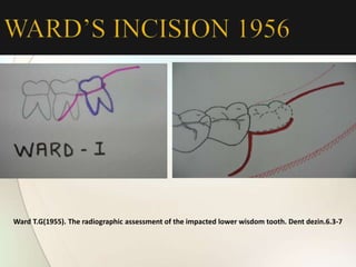 Ward T.G(1955). The radiographic assessment of the impacted lower wisdom tooth. Dent dezin.6.3-7
 